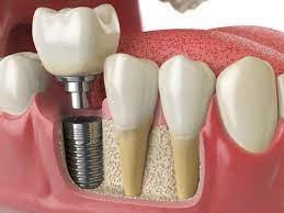 Implante dentário